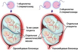 Схема многоплодной беременности