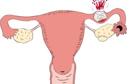 Внематочная беременность при низком ХГЧ