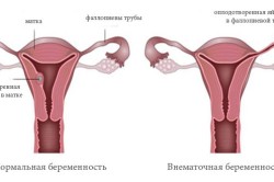 Внематочная беременность при медленном росте ХГЧ