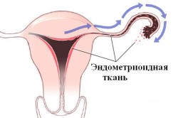 Расположение эндометриоидной ткани